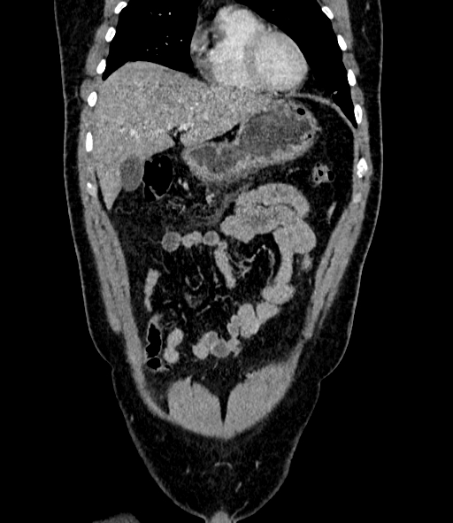 Acute pancreatitis (Radiopaedia 87428-103757 Coronal C+ portal venous phase 24).jpg