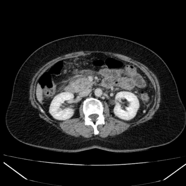 Acute pancreatitis - Balthazar C (Radiopaedia 26569-26714 Axial C+ portal venous phase 45).jpg