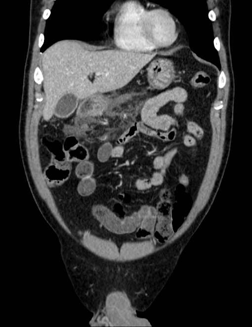 Acute pancreatitis - Balthazar E (Radiopaedia 23080-23110 Coronal C+ portal venous phase 19).jpg