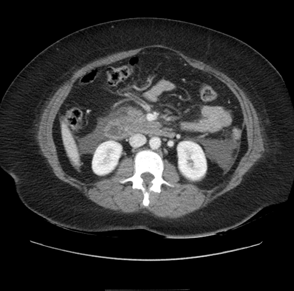 File:Acute pancreatitis - Balthazar E (Radiopaedia 29016-29377 Axial C+ portal venous phase 32).png