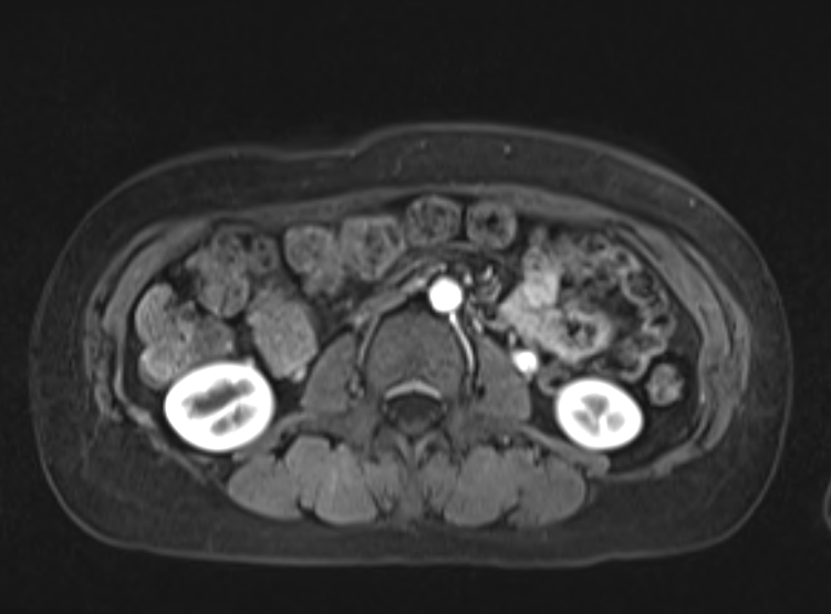 Acute pancreatitis - Balthazar E - post ERCP (Radiopaedia 27562-27778 Axial VIBE C+ 66).png