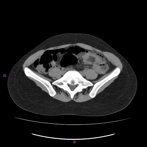 Acute pancreatitis secondary to stone at minor papilla and pancreatic divisum (Radiopaedia 76570-88333 Axial non-contrast 51).jpg