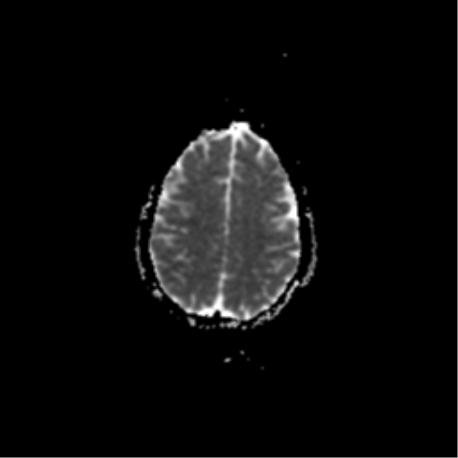 File:Acute pontine infarct from vertebral artery dissection (Radiopaedia 34111-35370 Axial ADC 17).png