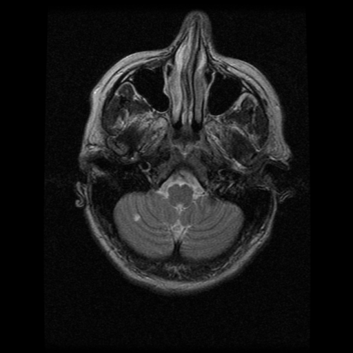 File:Acute pontine infarct from vertebral artery dissection (Radiopaedia 34111-35370 Axial T2 3).png