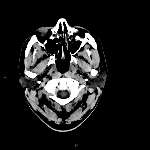 Acute posterior cerebral artery territory infarct (Radiopaedia 79329-92393 Axial non-contrast 4).jpg