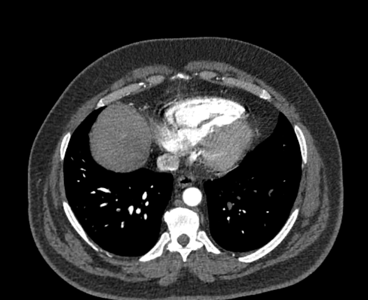 Acute pulmonary embolism with pulmonary infarcts (Radiopaedia 77688-89908 Axial C+ CTPA 49).jpg