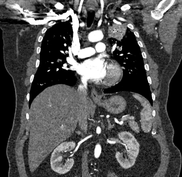 Acute pulmonary embolism with pulmonary infarcts (Radiopaedia 77688-89908 Coronal C+ CTPA 46).jpg