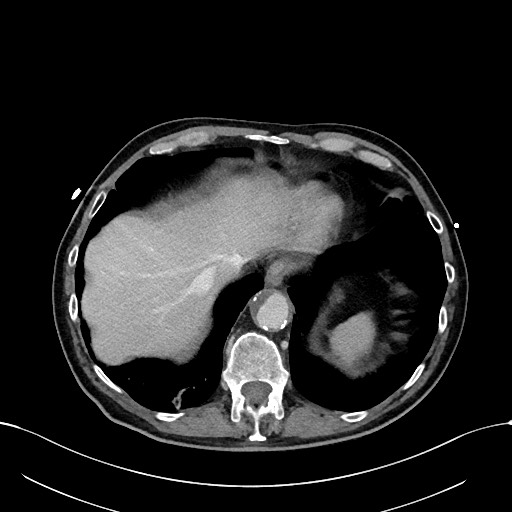 Acute renal infarction (Radiopaedia 59375-66736 Axial C+ portal venous phase 10).jpg