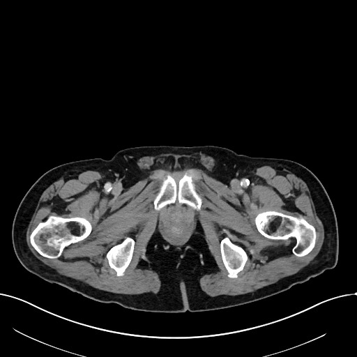 File:Acute renal infarction (Radiopaedia 59375-66736 Axial C+ portal venous phase 124).jpg
