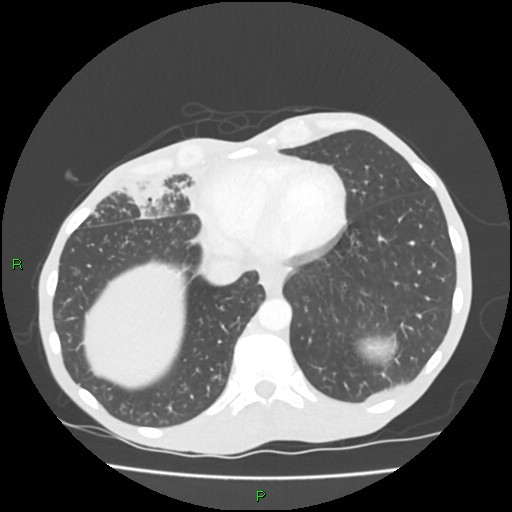 Acute right lung abscess (Radiopaedia 34806-36258 Axial lung window 149).jpg