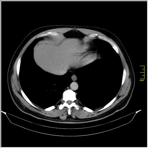 Acute right sided diverticulitis (Radiopaedia 65249-74268 Axial C+ portal venous phase 5).JPG