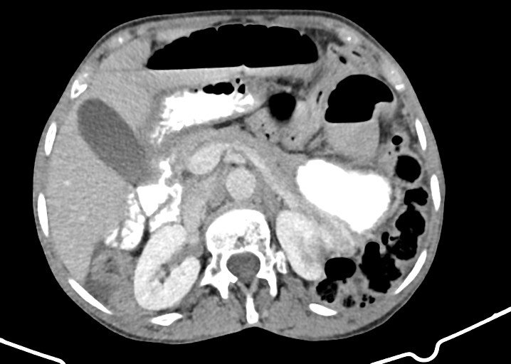 Acute small bowel (ileal) volvulus (Radiopaedia 71740-82139 Axial C+ portal venous phase 71).jpg