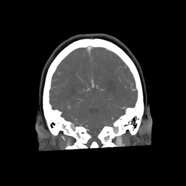 Acute subarachnoid hemorrhage and accessory anterior cerebral artery (Radiopaedia 69231-79009 Coronal C+ arterial phase 58).jpg