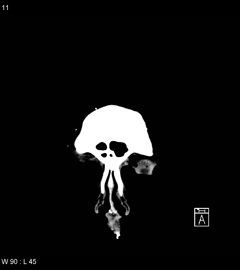 Acute subdural hematoma with myelofibrosis (Radiopaedia 52582-58494 Coronal non-contrast 2).jpg