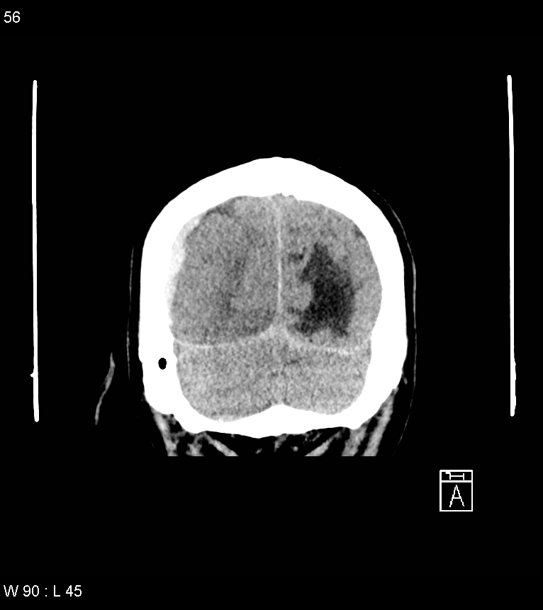 Acute subdural hematoma with myelofibrosis (Radiopaedia 52582-58494 Coronal non-contrast 47).jpg