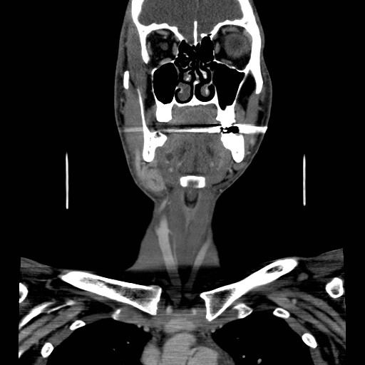 File:Acute submandibular sialadenitis secondary to ductal stone (Radiopaedia 27999-28267 D 20).jpg