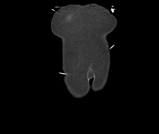 File:Acute superior mesenteric artery occlusion (Radiopaedia 43926-47418 Coronal C+ portal venous phase 4).png