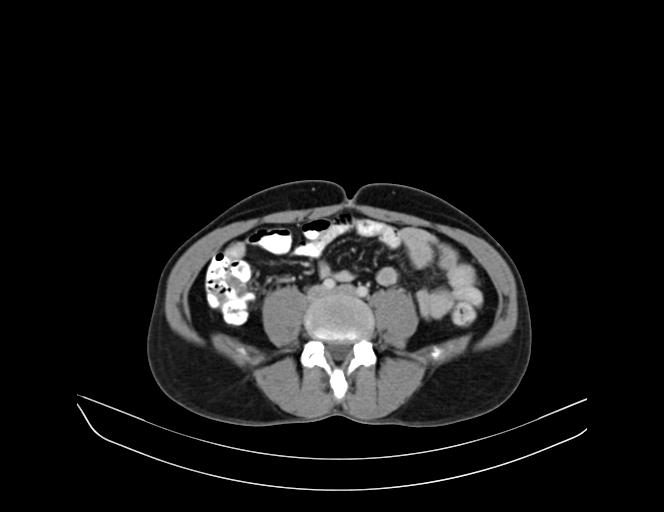 Addison disease (Radiopaedia 49318-54412 Axial C+ portal venous phase 54).jpg