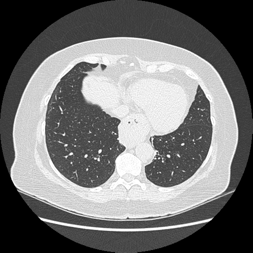Adenocarcinoma in situ of lung (Radiopaedia 38685-40829 B 167).png