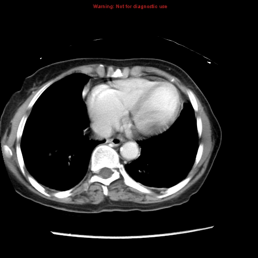 File:Adenocarcinoma of the colon (Radiopaedia 8191-9039 Axial liver window 6).jpg