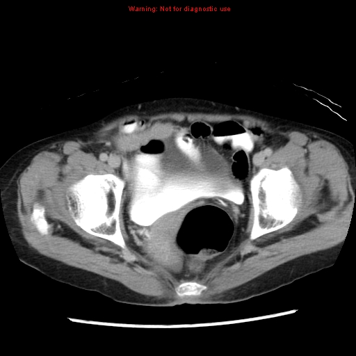 Adenocarcinoma of the colon (Radiopaedia 8191-9039 Axial renal excretory phase 55).jpg