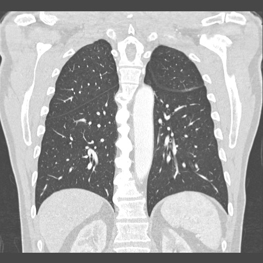 Adenocarcinoma of the lung (Radiopaedia 59871-67325 Coronal lung window 44).jpg