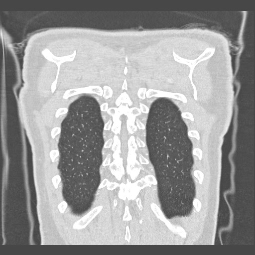 Adenocarcinoma of the lung (Radiopaedia 59871-67325 Coronal lung window 60).jpg
