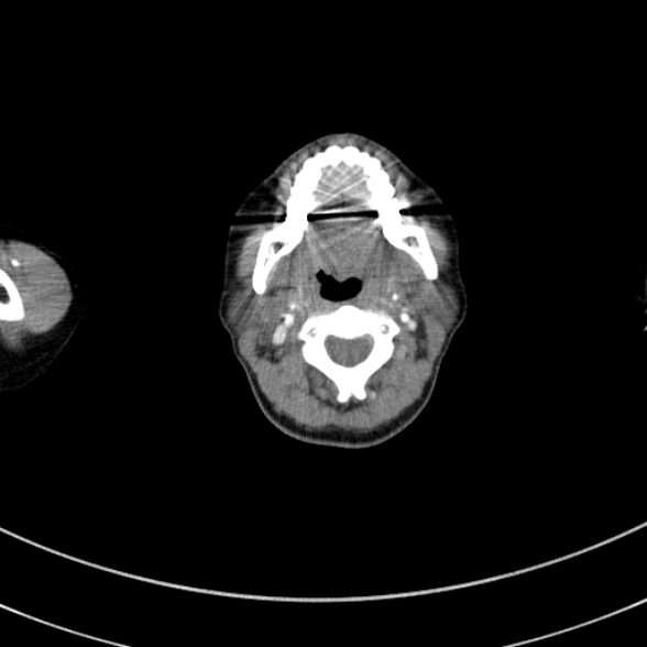 Adenocystic carcinoma of the trachea (Radiopaedia 47677-52525 Axial C+ arterial phase 11).jpg