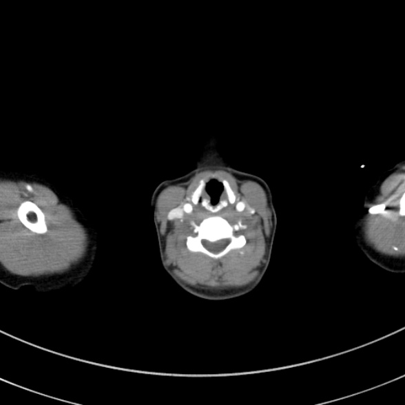 Adenocystic carcinoma of the trachea (Radiopaedia 47677-52525 Axial C+ arterial phase 20).jpg
