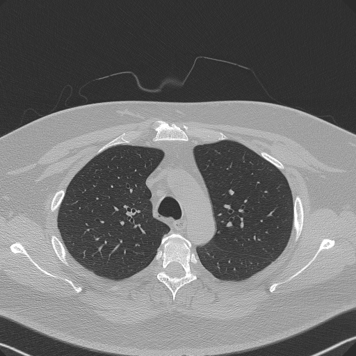 Adenoid cystic carcinoma of the trachea (Radiopaedia 49042-54137 Axial lung window 96).jpg