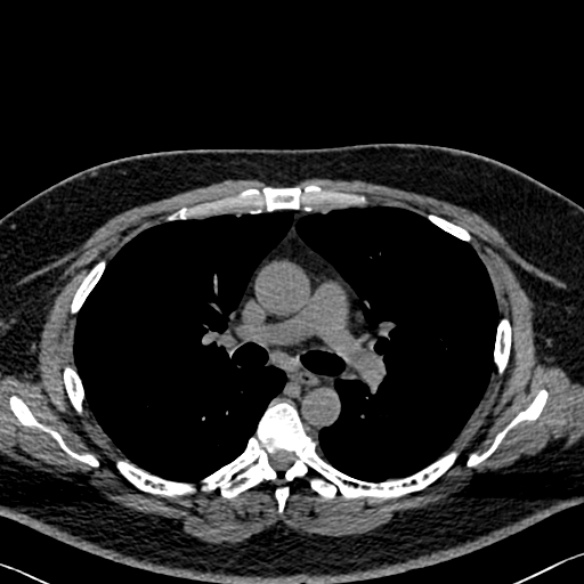 File:Adenoid cystic carcinoma of the trachea (Radiopaedia 49042-54137 Axial non-contrast 144).jpg