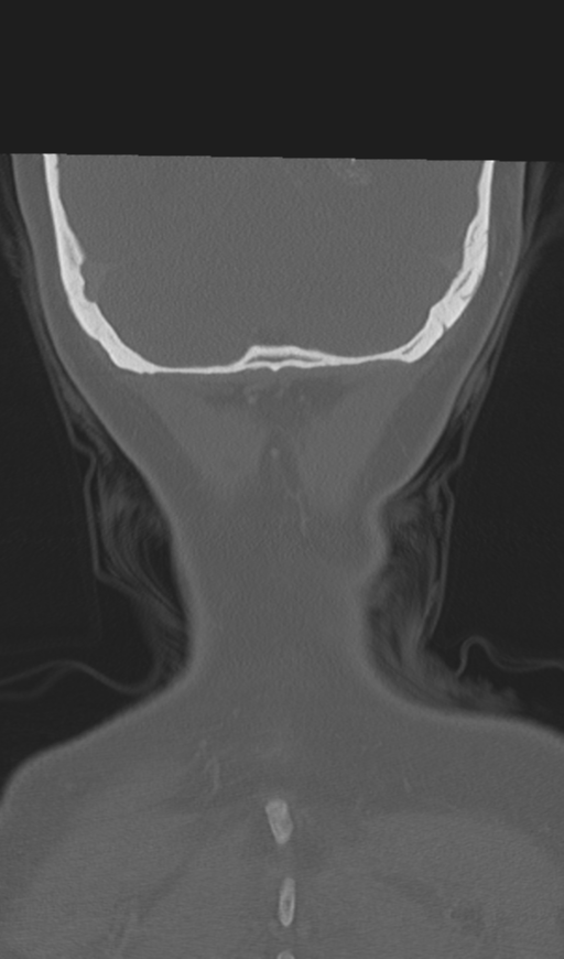 Adenoid cystic tumor of palate (Radiopaedia 46980-51518 Coronal bone window 56).png
