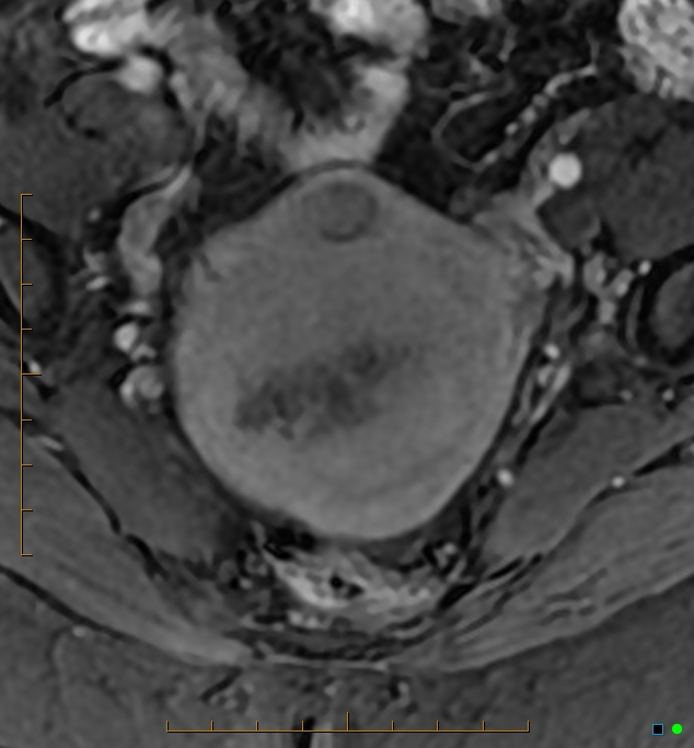 Adenomyosis uterus with hematometra (Radiopaedia 45779-50011 Axial T1 C+ fat sat 16).jpg