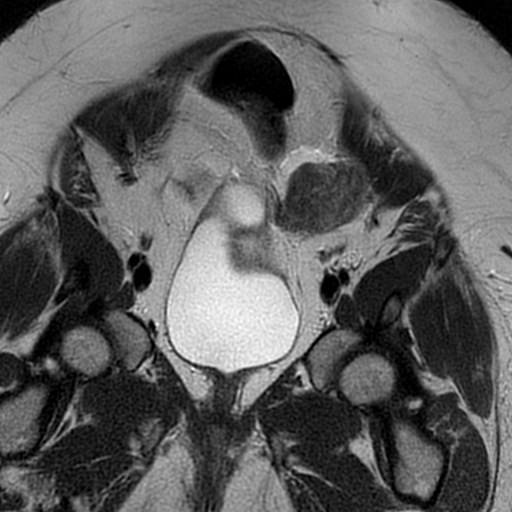 File:Adenomyosis within a didelphys uterus (Radiopaedia 70175-80215 Coronal T2 10).jpg