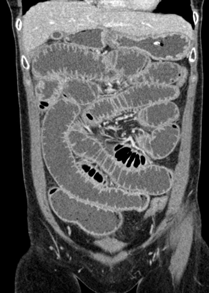Adhesional small bowel obstruction (Radiopaedia 48397-53305 Coronal C+ portal venous phase 107).jpg