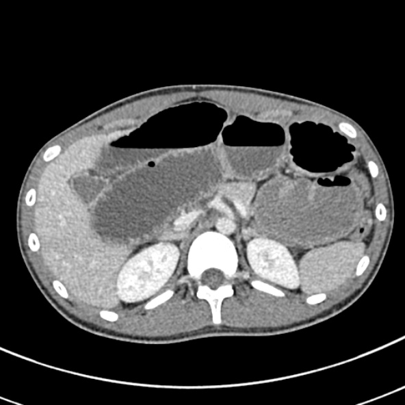 File:Adhesional small bowel obstruction (Radiopaedia 52107-57980 Axial C+ portal venous phase 32).jpg