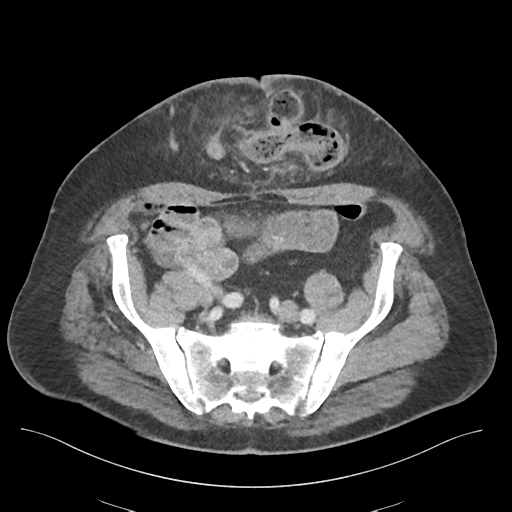 Adhesions within abdominal wall hernia (Radiopaedia 58283-65394 Axial C+ portal venous phase 64).png