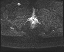 Adnexal multilocular cyst (O-RADS US 3- O-RADS MRI 3) (Radiopaedia 87426-103754 Axial DWI 28).jpg
