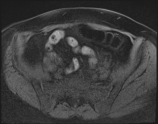 File:Adnexal multilocular cyst (O-RADS US 3. O-RADS MRI 3) (Radiopaedia 87426-103754 Axial 211).jpeg