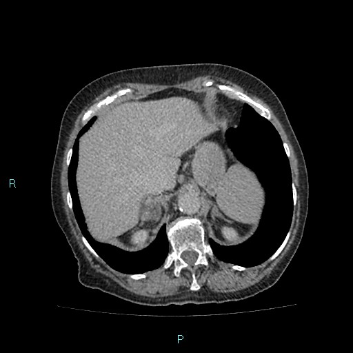 File:Adrenal collision tumor (ACT) (Radiopaedia 48462-53379 Axial C+ delayed 12).jpg