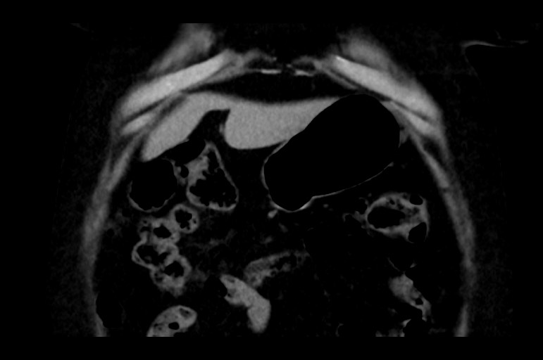 Adrenal cortical carcinoma (Radiopaedia 64017-72769 Coronal non-contrast 11).jpg