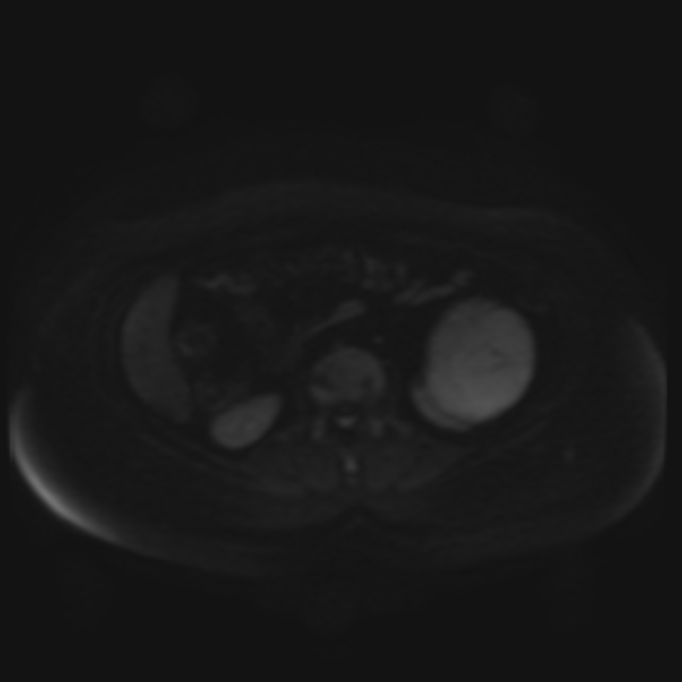 Adrenal cortical carcinoma (Radiopaedia 70906-81116 Axial DWI 47).jpg