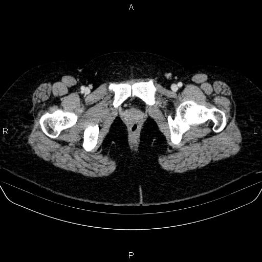 Adrenal cortical carcinoma (Radiopaedia 84882-100379 Axial C+ portal venous phase 98).jpg