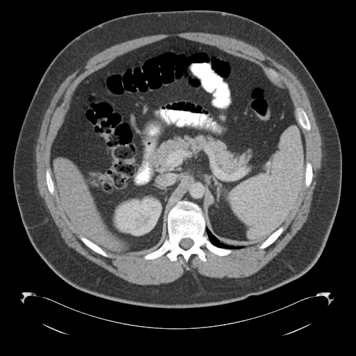 Adrenal cyst (Radiopaedia 45625-49776 Axial C+ portal venous phase 32).png