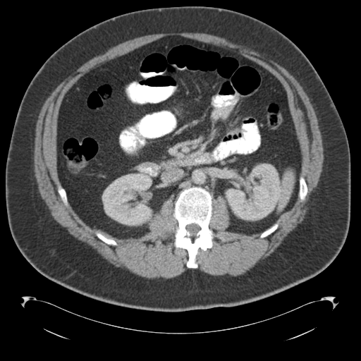 Adrenal cyst (Radiopaedia 45625-49776 Axial C+ portal venous phase 42).png
