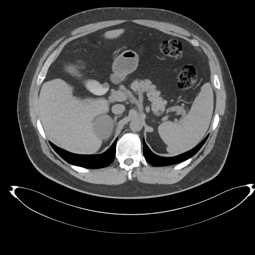 File:Adrenal cyst (Radiopaedia 45625-49778 Axial non-contrast 27).png