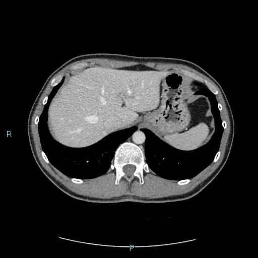 File:Adrenal cystic lymphangioma (Radiopaedia 83161-97534 Axial C+ portal venous phase 18).jpg