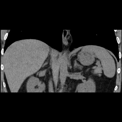 Adrenal gland trauma (Radiopaedia 81351-95079 Coronal non-contrast 52).jpg