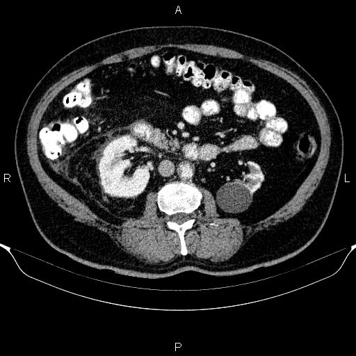 Adrenal hemorrhage (Radiopaedia 62622-70916 Axial C+ portal venous phase 89).jpg