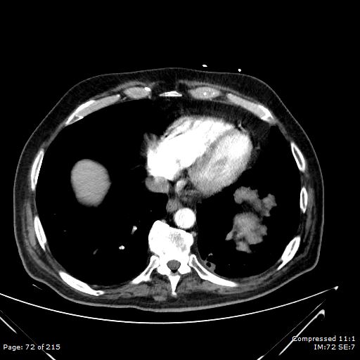 Adrenal metastasis (Radiopaedia 78425-91079 Axial C+ arterial phase 2).jpg